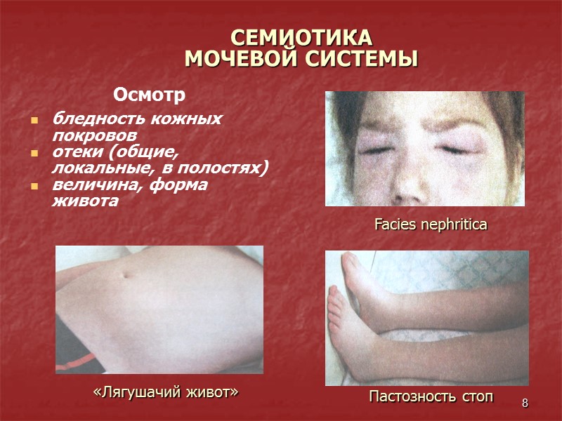 8 СЕМИОТИКА   МОЧЕВОЙ СИСТЕМЫ Осмотр  бледность кожных покровов отеки (общие, локальные,